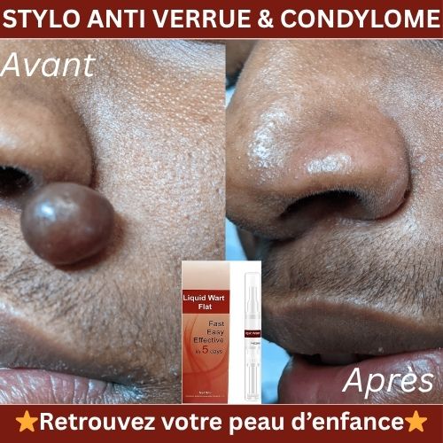HUILE ANTI-VERRUES, ACCROCHORDONS ET CONDYLOMES 100% EFFICACE